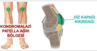 Kondromalazi-patella-nedir