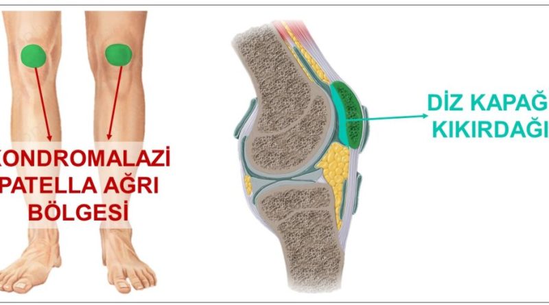 Kondromalazi-patella-nedir