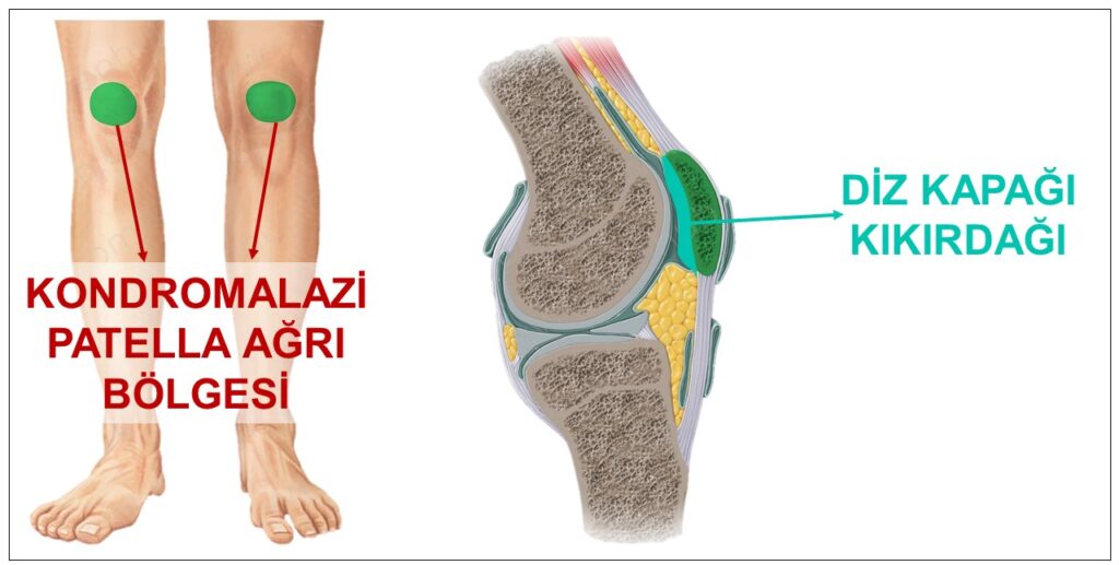 Kondromalazi Patella Nedir ?