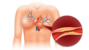 kolesterol-icin-alinmasi-sart-ilaclar