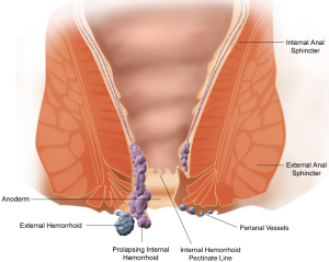 hemoroid-basur-nedir-hangi-ilaclar-kullanilmali