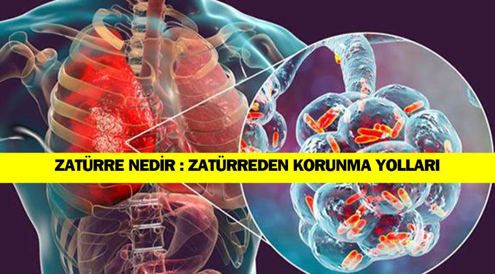 Zatürre Nedir : Zatüre’den Korunmanın Yolları