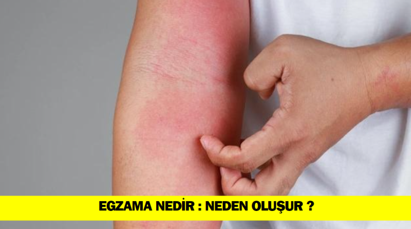 egzama-nedir-egzama-neden-ortaya-cikar