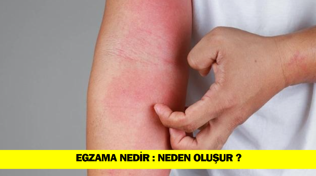 Egzama Nedir : Egzama Neden Ortaya Çıkar ?